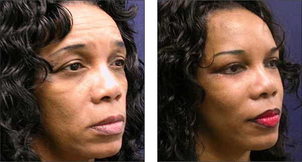 Chicago facelift surgeon cosmetic
